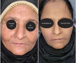 Best Dental Clinic in Ghaziabad | Dental Park Thread Lift Surgery