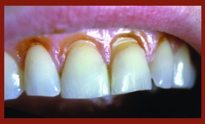 Best Dental Clinic in Ghaziabad | Dental Park Abfraction