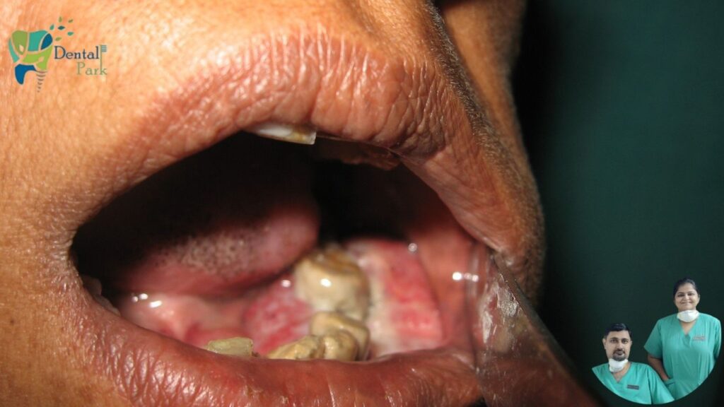 Oral Cancer Screening