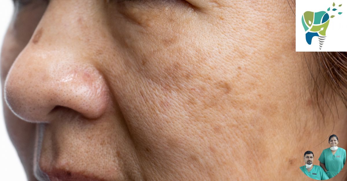 oral melanotic macule inside cheek 7 Warning Signs of Pigmented Lesions: A Dentist's Guide to Causes & Care