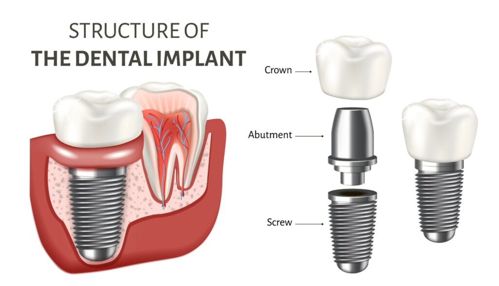 Tooth implant