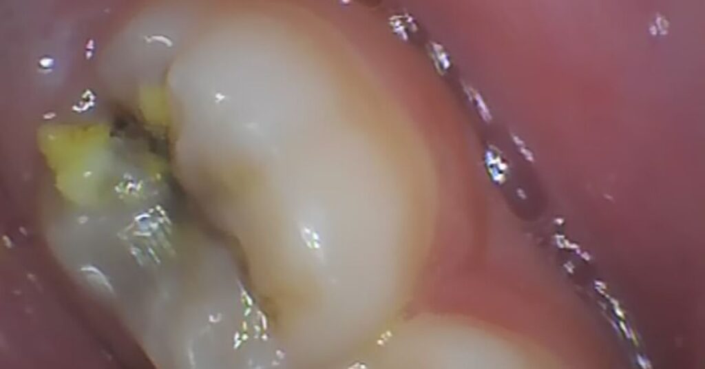 Best Dental Clinic in Ghaziabad | Dental Park best-dental-cavity-treatment-dentist-in-shastri-nagar-ghaziabad