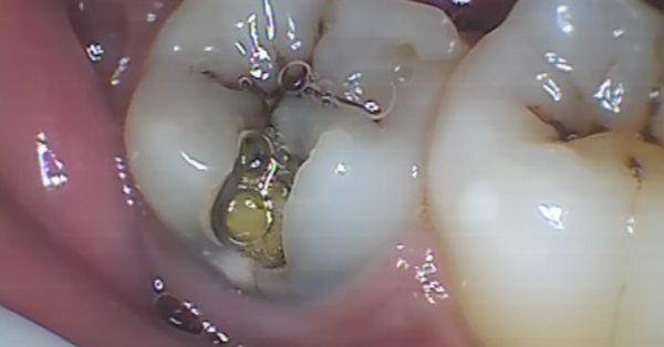 Visible Holes