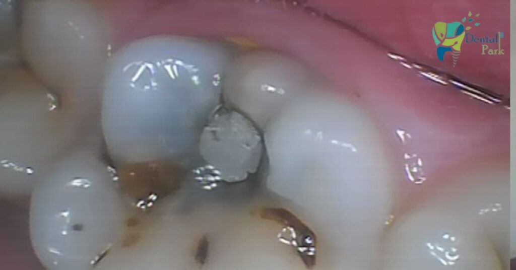 Close-up view of an old silver amalgam filling showing significant marginal leakage and tooth discoloration.