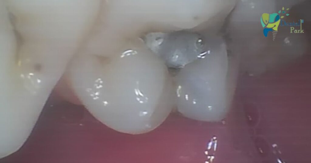 Close-up of a weathered silver amalgam filling in a molar tooth at Dental Park Ghaziabad