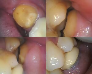 Dislodged PFM dental crown showing poor marginal adaptation and ceramic chipping vs professional dental prep in Ghaziabad