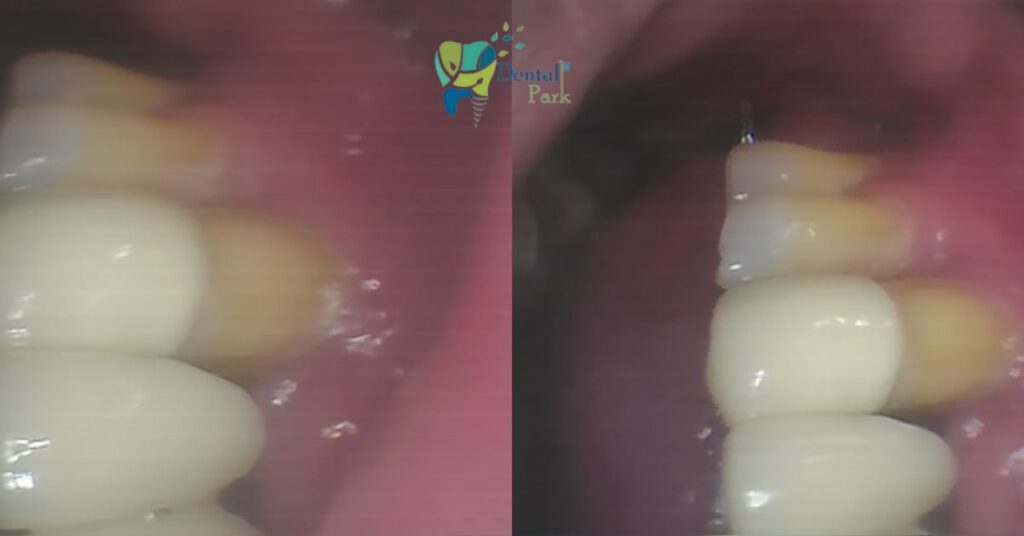 Intraoral view showing food lodgement gap between the gum line and a dental bridge caused by jawbone resorption in an extracted tooth region.