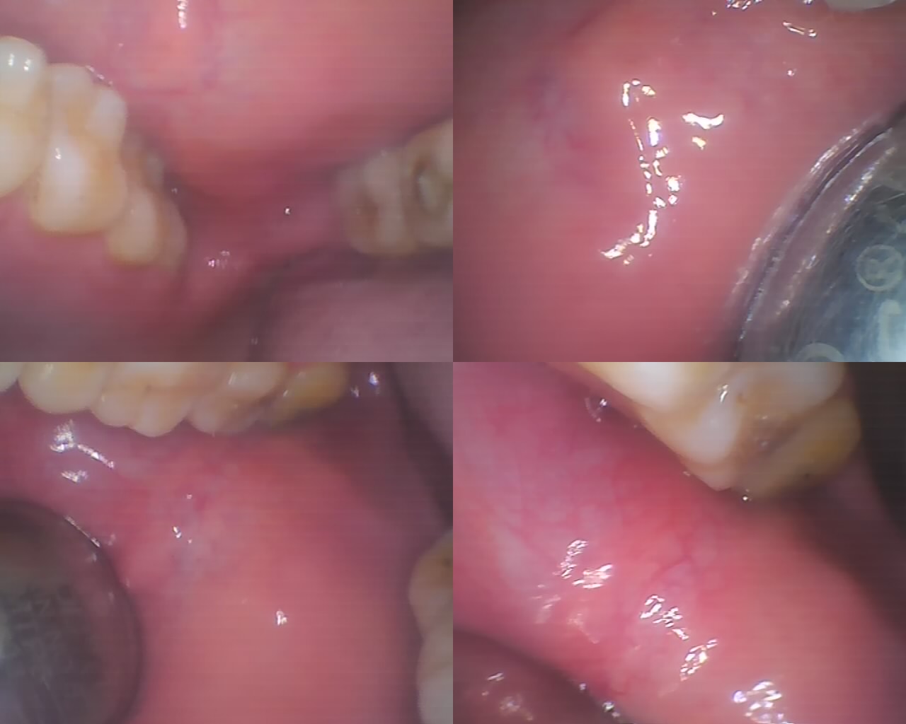 Best Dental Clinic in Ghaziabad | Dental Park Clinical view of Stensen duct opening in buccal mucosa