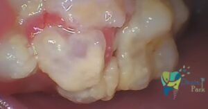 Severe dental crowding with massive plaque accumulation and inflamed gums, illustrating risks leading to tooth loss.
